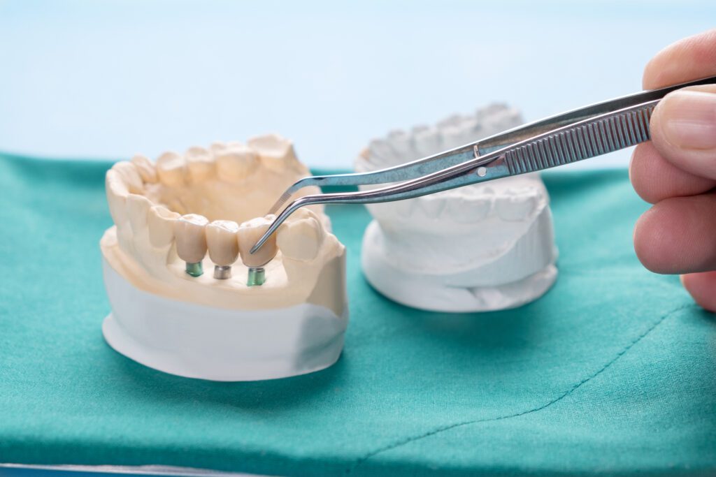 Dental Bridge Treatment in Fairfax, Virginia