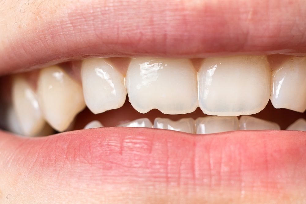 Is Your Flossing Helping or Hurting?