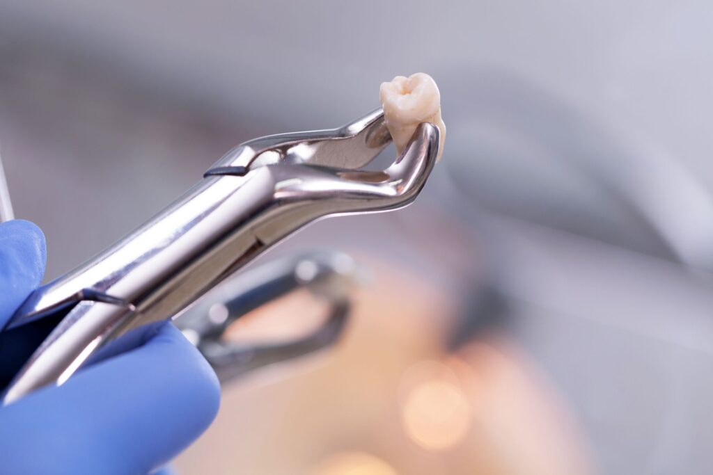 Wisdom Teeth Extraction
